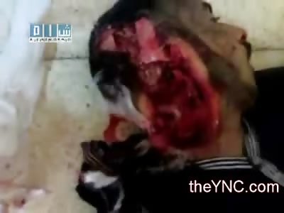 Extraordinary Head Trauma...Man has back of Head Blown Off