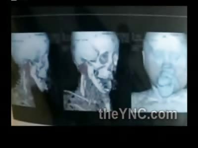 WTMF: Very Sad This Poor Kid has a Terrible Tongue Affliction 