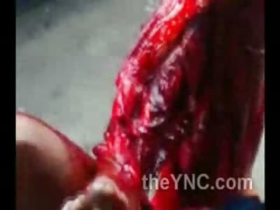 Skin Peel: Man has his entire Quadricep Mucles Exposed to the Elements after a Bad Accident