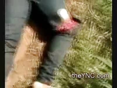 Man Flailing in the Street has Arm Totally Severed from Shoulder Socket 