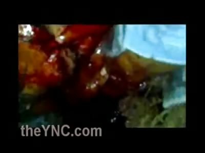 Man with back of his Skull Blown Out looks Very Uncomfortable