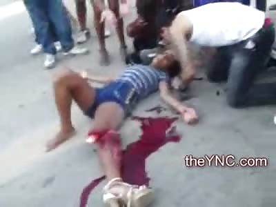 Female with Great Legs has Horrific Compound Fracture 