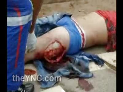 Leg Tear is Painful to Look at 