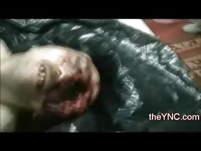 Left Side of Man's Face Missing from Torture