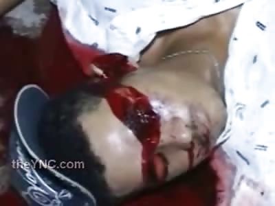 Man Shot to Death Dies ... Blood Forms Blood Goggles Around his Eyes