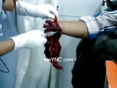Man with Hand Blown Completely Off is Injected with some Pain Relief