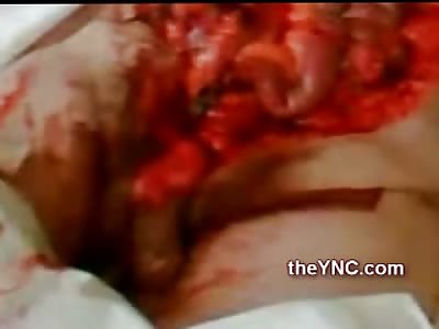 Stomach Exposed and Ripped Open Man Fighting for Life