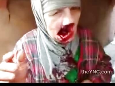 Elderly Woman Shot in Face...Huge Gaping Hole is left