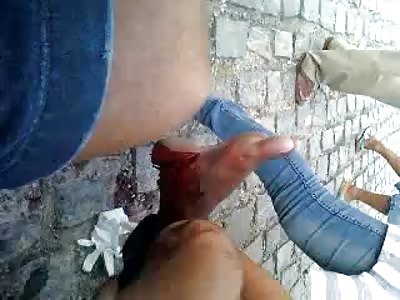 Nasty Foot Severed and Bleeding on the Road