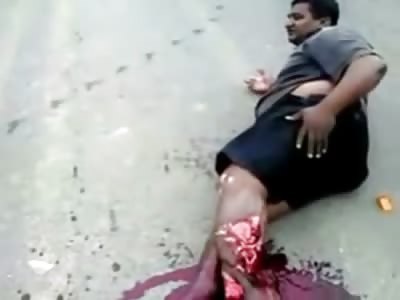Man Leg in Horrific Shape