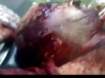 Man Shot in the Head Still Alive and Moving on Bed