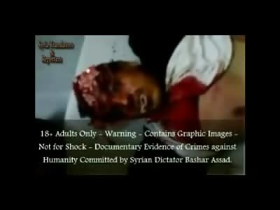 Man takes his Final Reflex Breaths with Brains Exposed