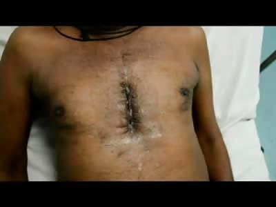 Dont Cough too Hard after Heart Surgery Please Please