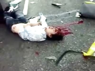 Man Still Breathing with half His Head Gone after Horrible Accident