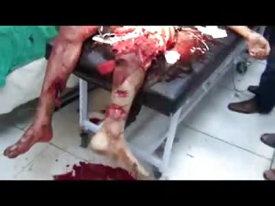 Time of Death....Doctors gave up on Man Blown Apart by RPG