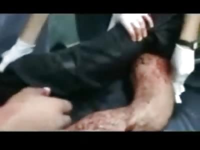 Syrian Free Fighter lost his Hand and is Damn Proud of it!