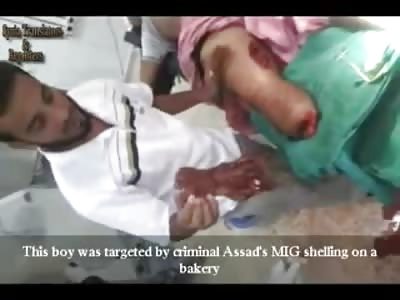 Very Professional Arabic Doctor Show Foot He Just Amputated off of Young Kid