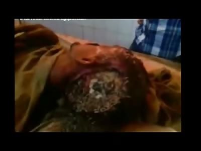 Disgusting Maggots Festering inside Mans Head