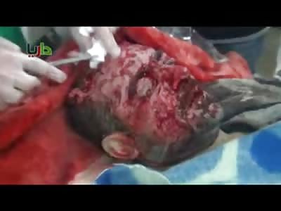 Alive Man has Shrapnel Twisted out of his Flesh 