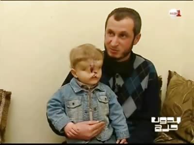 Sad Shocking Video of 2 Year Old Boy with Terrible Facial Deformity (Comments Disabled) 