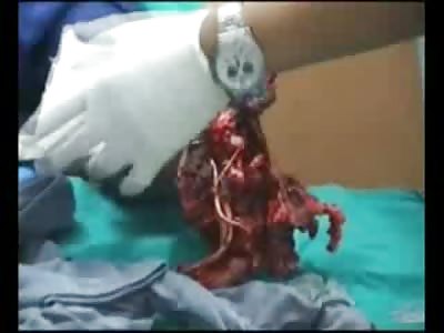 Man blew his Hand off Screaming for Help in the Hospital