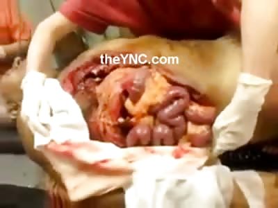 You can see how the Lungs move your Guts Around because of this Mans Chest Injury