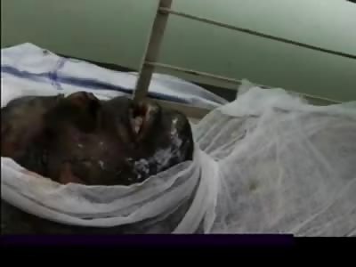 Man in Hospital Talks after Purposely setting Himself on Fire