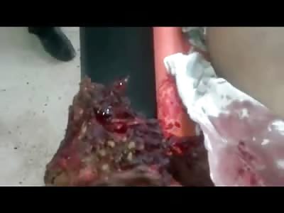 Boy has both Arms Blown Off and Still Alive from Grabbing a Landmine