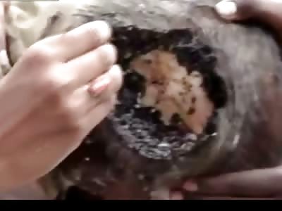 Man in India Suffers From Disgusting Infestation