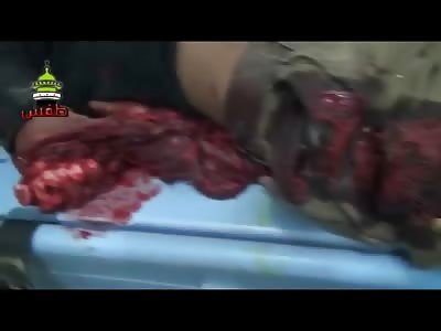 Think the Elbow is FUBAR'd Beyond Repair..... Don't Think Your Leg is Doing to Good Either