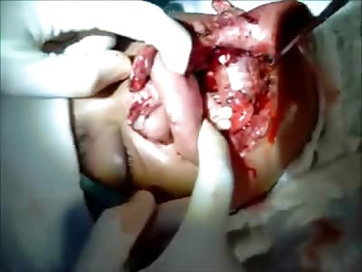 Boy with Horribly Disfigured Face after Car Accident