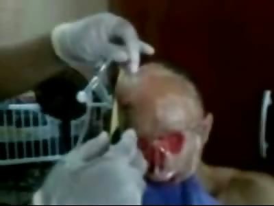 Shocking Video of Man struck by Lightning had his Face Blown off.. His Wife puts Bandages on his Face