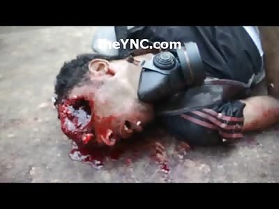 Being Shot Through the Left Eye.....Leaves Quite the Hole