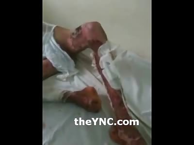 Suffering Man with horrific Painful Burns had Feet Fried off from Electricity