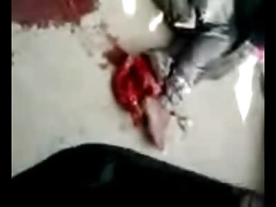 Man with his Severed Foot Flapping Around in Pain