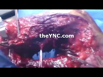 Man with Amazing Leg Trauma you can See Right though It
