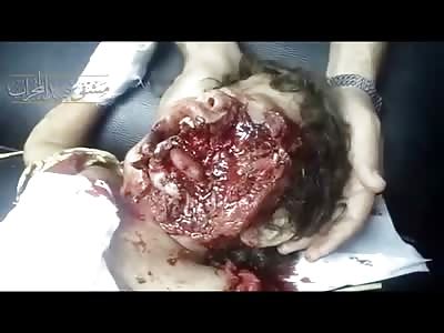 HORROR: Half of Poor Little Girls Face is all but Gone...Still Breathing you can See her tongue 