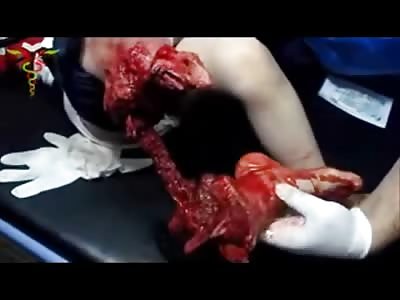 VERY SAD: Little Boy Crying on the Table, His Lower Leg Being Removed