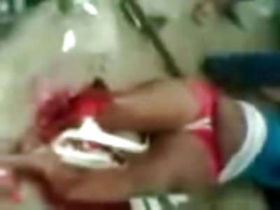 Woman Loses her Leg in Terrible Accident 