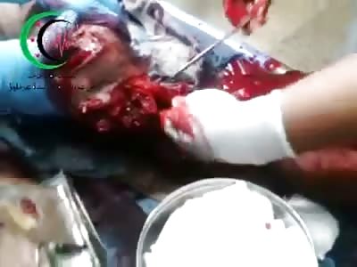 Doctor Twists a Mans Leg off in the Operating Room