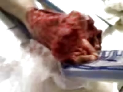 Raw Foot Skin is Peeled Back by the Doctors