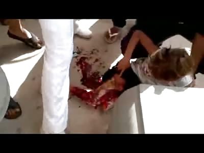 Poor Kids Leg is Completely Skinned in Terrible Accident