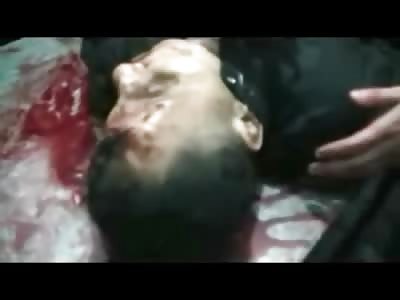 Mother of Man with half a Face Cries to the Camera