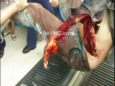 Machete Turns Mans Arms into Sliced Meat