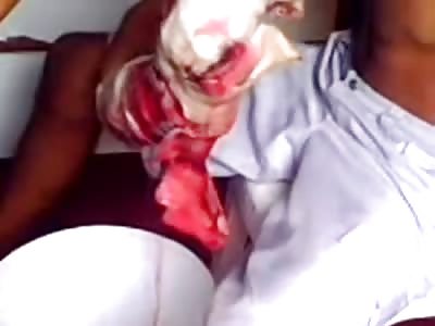 Man Skin Literally Ripped off of His Arm