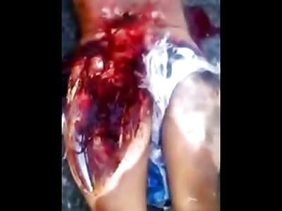 Man Torso Ripped Wide Open from Horrible Accident as his Car Burns