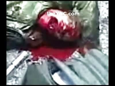 Colombian Soldier Gasping for Breath after Bullet Shot to the Throat (Hole to the Throat is shown at 1:20) 