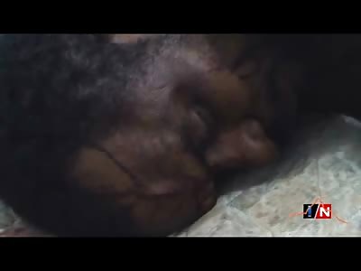 The Gorey Slice from a Machete on this Mans Back