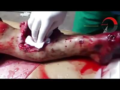 Shrapnel being Removed from Little Boys Mangled Legs