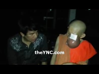 Man with Horrible Tumor Affliction